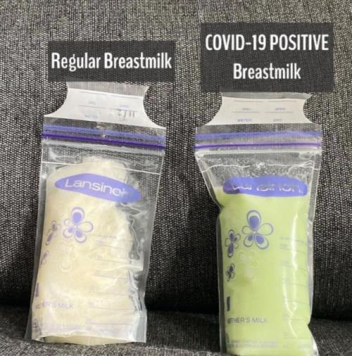 Bạn có thể thấy rõ sự khác biệt về màu sắc của sữa mẹ bình thường và sữa mẹ dương tính với Covid-19.